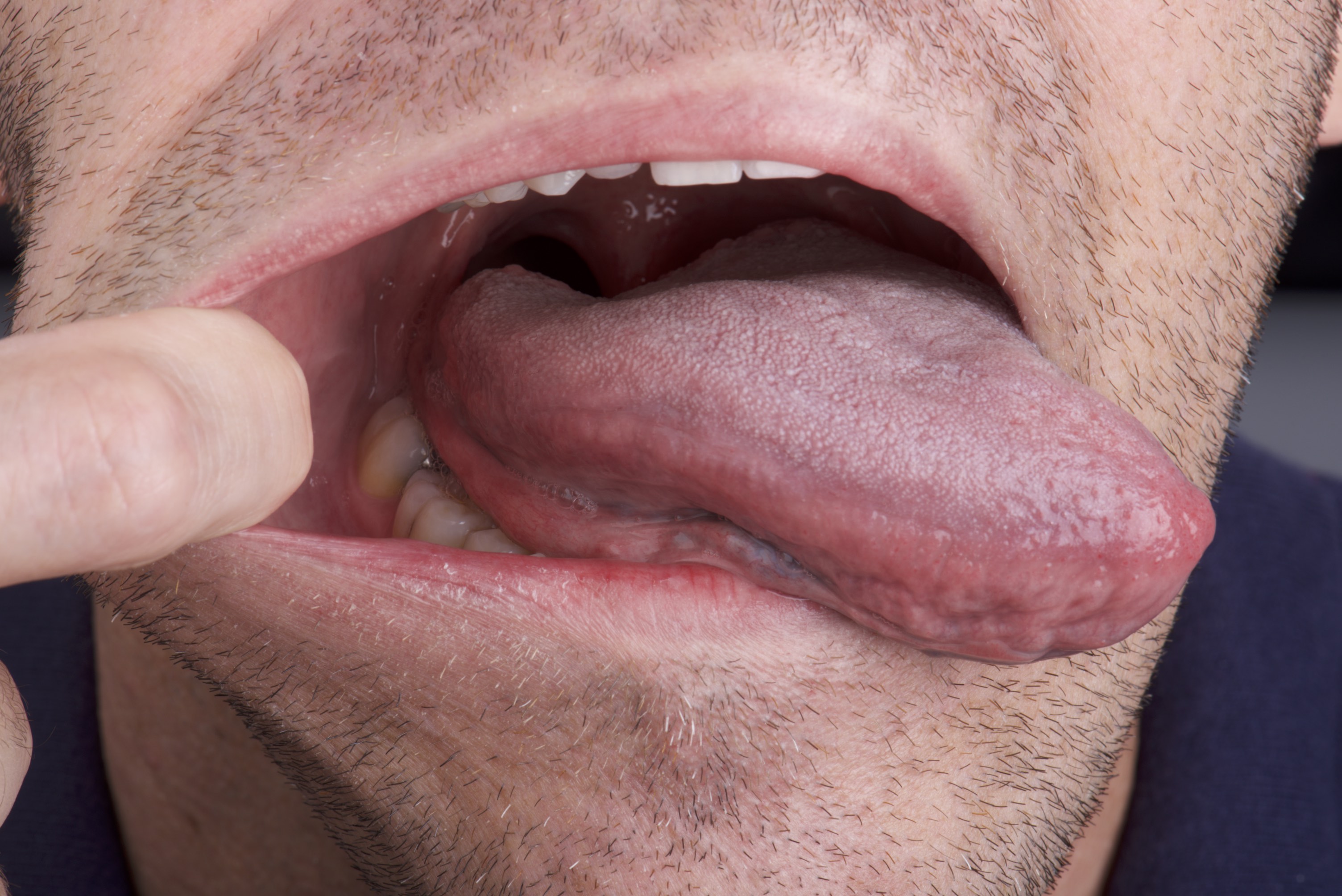 Mouth Cancer On Side Of Tongue CancerWalls